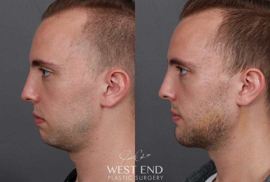 Chin & Mandibular Angle Implants before photo. Individual results may vary.