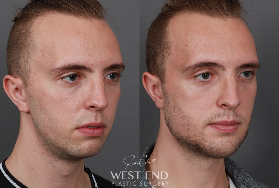 Chin & Mandibular Angle Implants before photo. Individual results may vary.