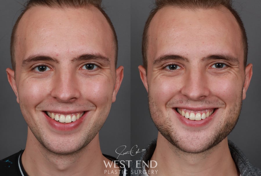 Chin & Mandibular Angle Implants before photo. Individual results may vary.