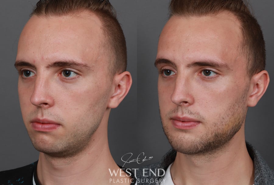 Chin & Mandibular Angle Implants before photo. Individual results may vary.