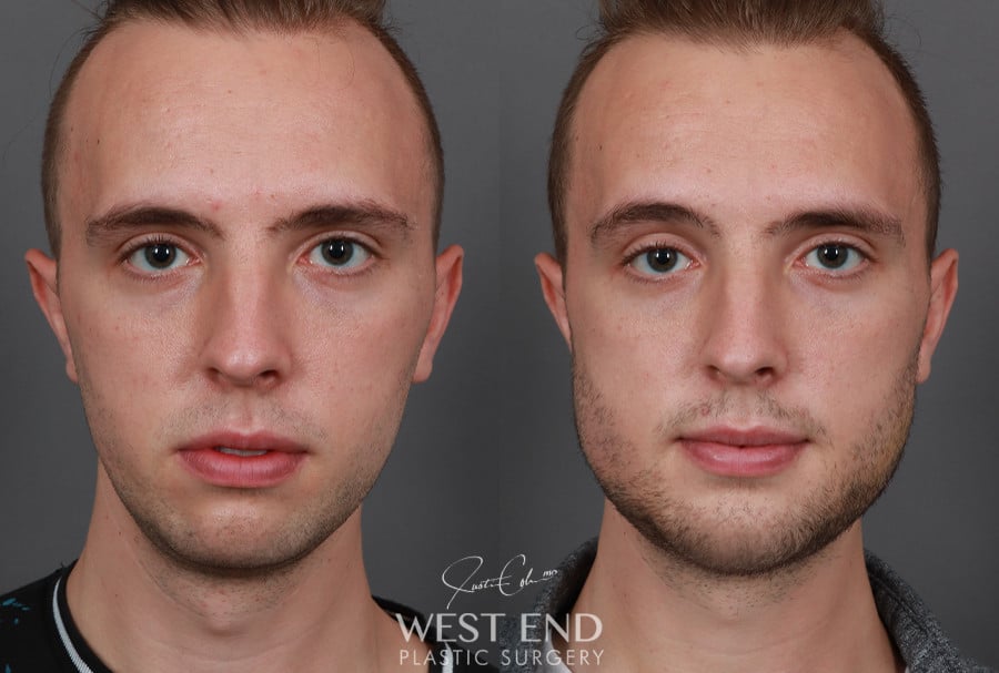 Chin & Mandibular Angle Implants before photo. Individual results may vary.