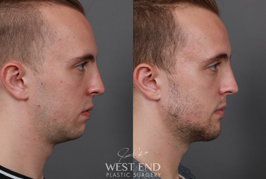 Chin & Mandibular Angle Implants before photo. Individual results may vary.