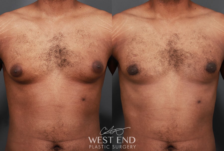 Gynecomastia (using Liposuction & Renuvion)