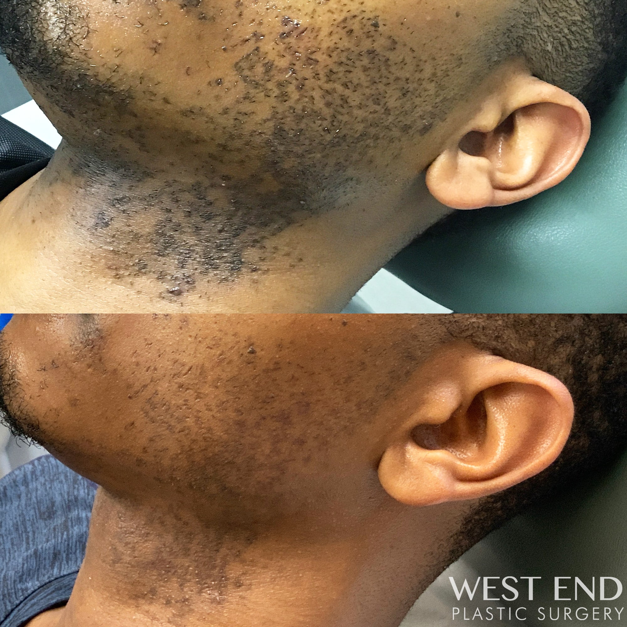 Laser Hair Removal & Chemical Peel