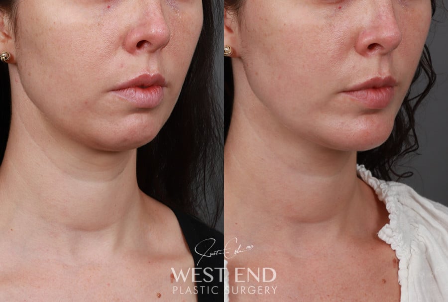 Chin Implant before photo. Individual results may vary.
