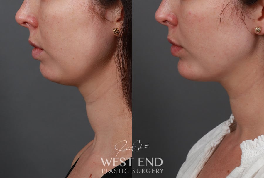 Chin Implant before photo. Individual results may vary.
