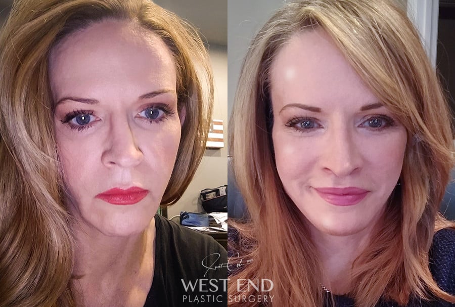 Extended Deep Plane Facelift, Neck Lift, Temporal Brow Lift, Upper Lip Lift, & CO2 Laser Resurfacing before photo. Individual results may vary.
