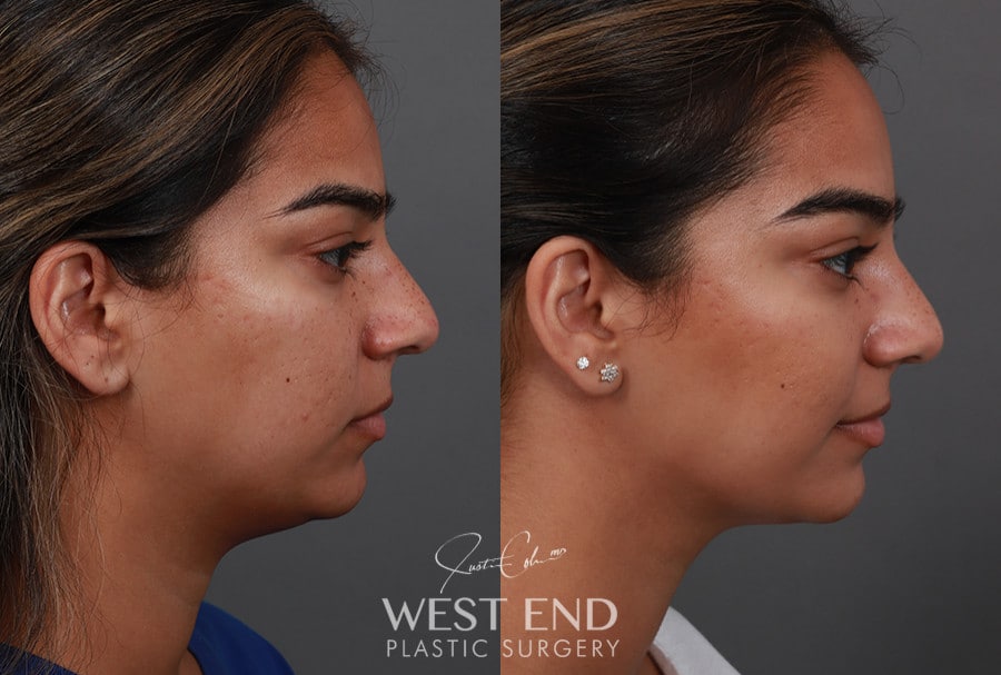 Submental Liposuction before photo. Individual results may vary.