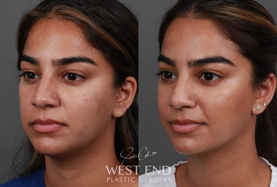 Submental Liposuction before photo. Individual results may vary.