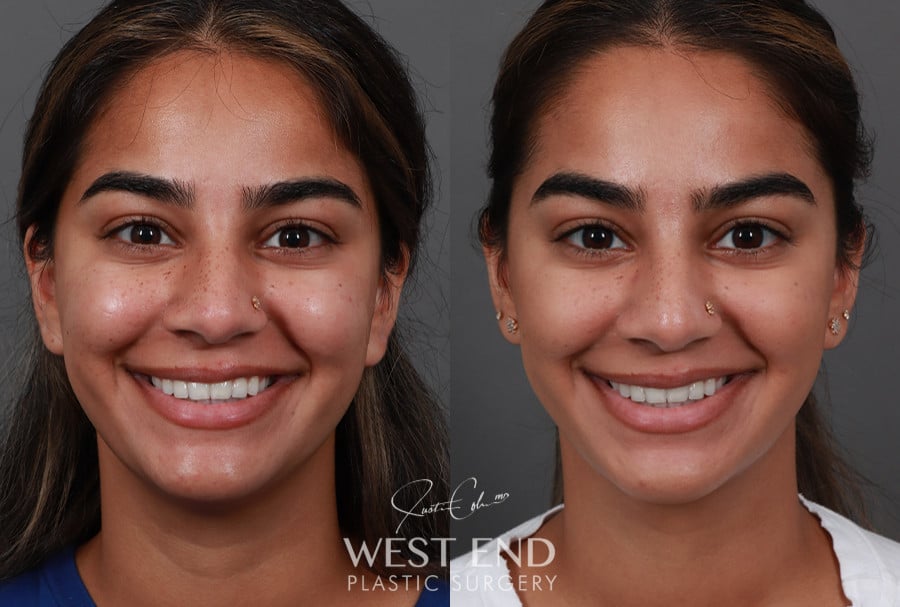 Submental Liposuction before photo. Individual results may vary.
