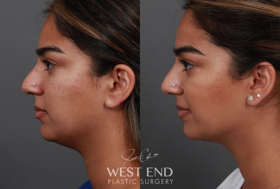 Submental Liposuction before photo. Individual results may vary.