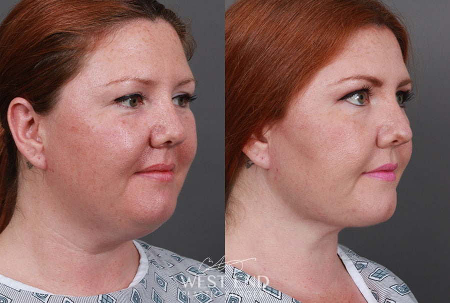 Submental Liposuction