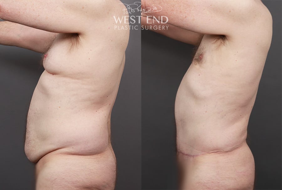 Tummy Tuck with Liposuction & Renuvion Skin Tightening (4 Months Post-Op)