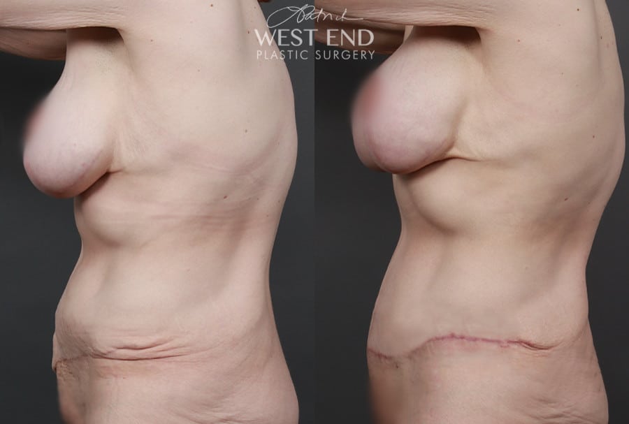 Tummy Tuck