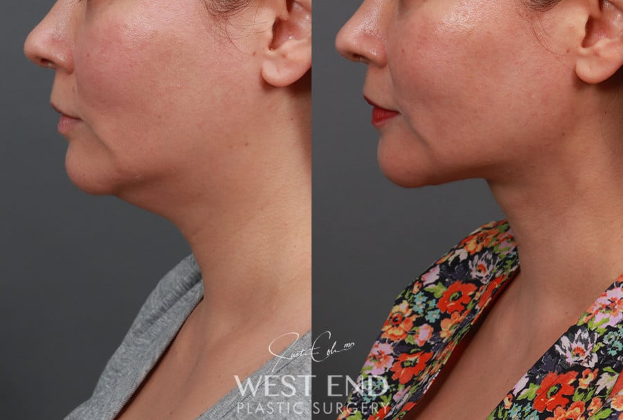 Submentoplasty (Deep Neck Lift) with Platysmaplasty before photo. Individual results may vary.