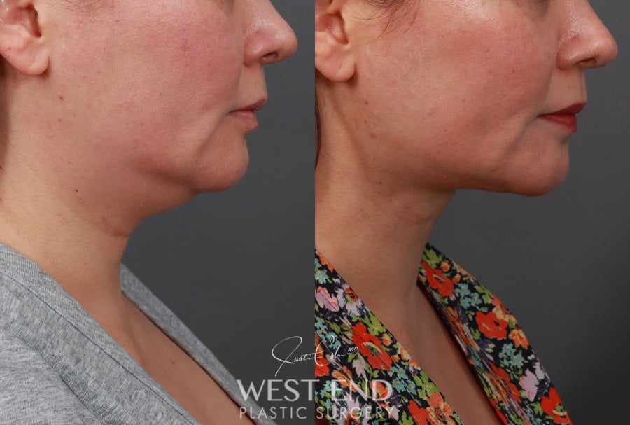 Submentoplasty (Deep Neck Lift) with Platysmaplasty before photo. Individual results may vary.