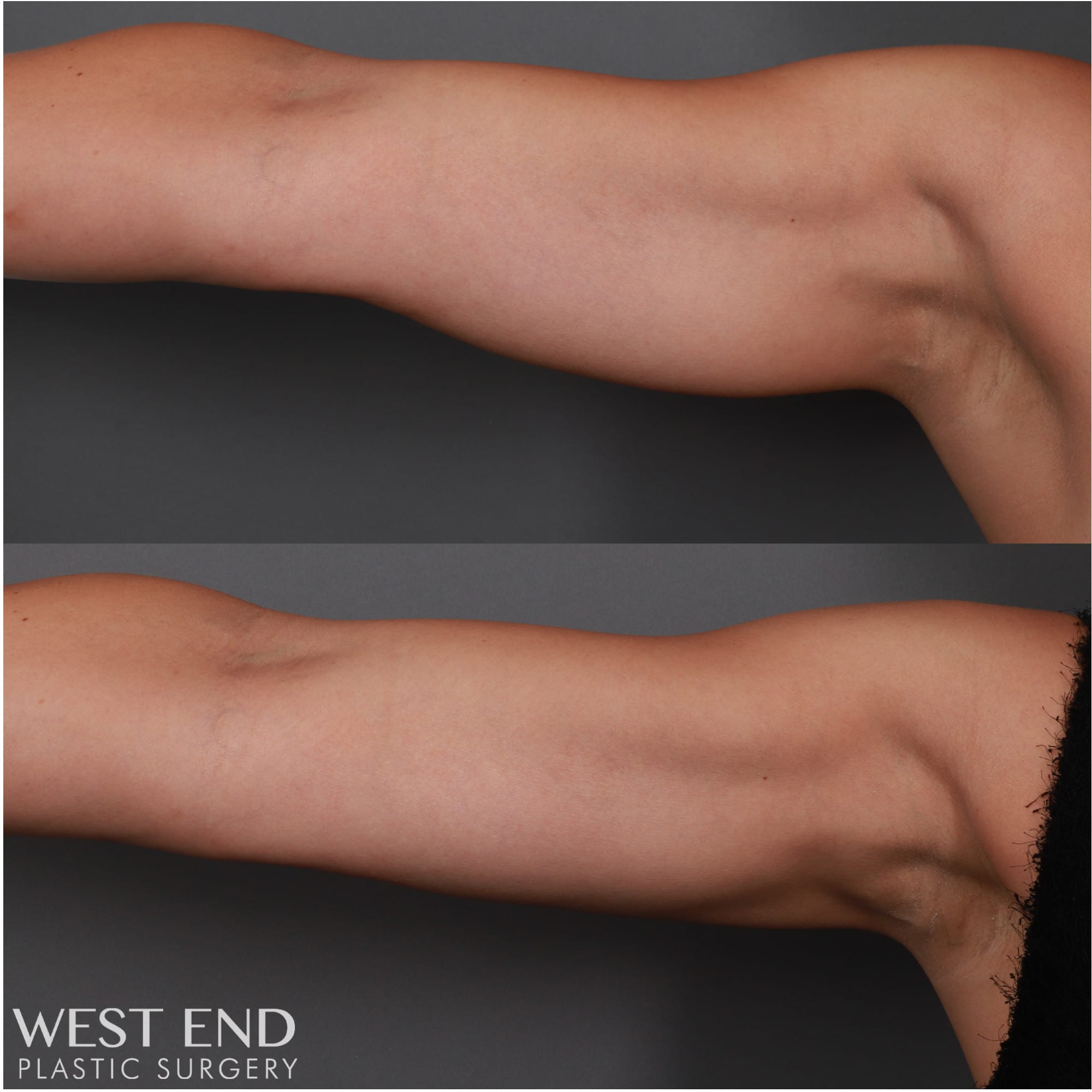 CoolSculpting