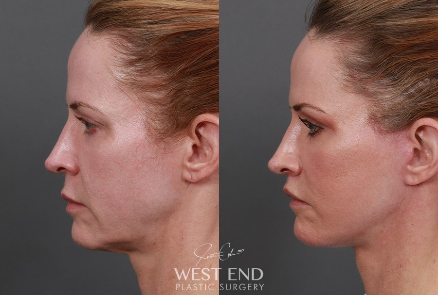 Extended Deep Plane Facelift, Neck Lift, Temporal Brow Lift, Upper Lip Lift, & CO2 Laser Resurfacing before photo. Individual results may vary.