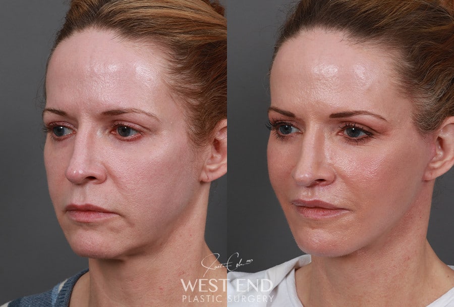 Extended Deep Plane Facelift, Neck Lift, Temporal Brow Lift, Upper Lip Lift, & CO2 Laser Resurfacing before photo. Individual results may vary.