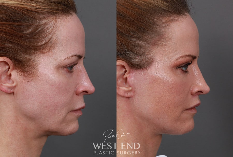 Extended Deep Plane Facelift, Neck Lift, Temporal Brow Lift, Upper Lip Lift, & CO2 Laser Resurfacing before photo. Individual results may vary.