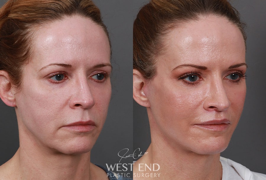 Extended Deep Plane Facelift, Neck Lift, Temporal Brow Lift, Upper Lip Lift, & CO2 Laser Resurfacing before photo. Individual results may vary.