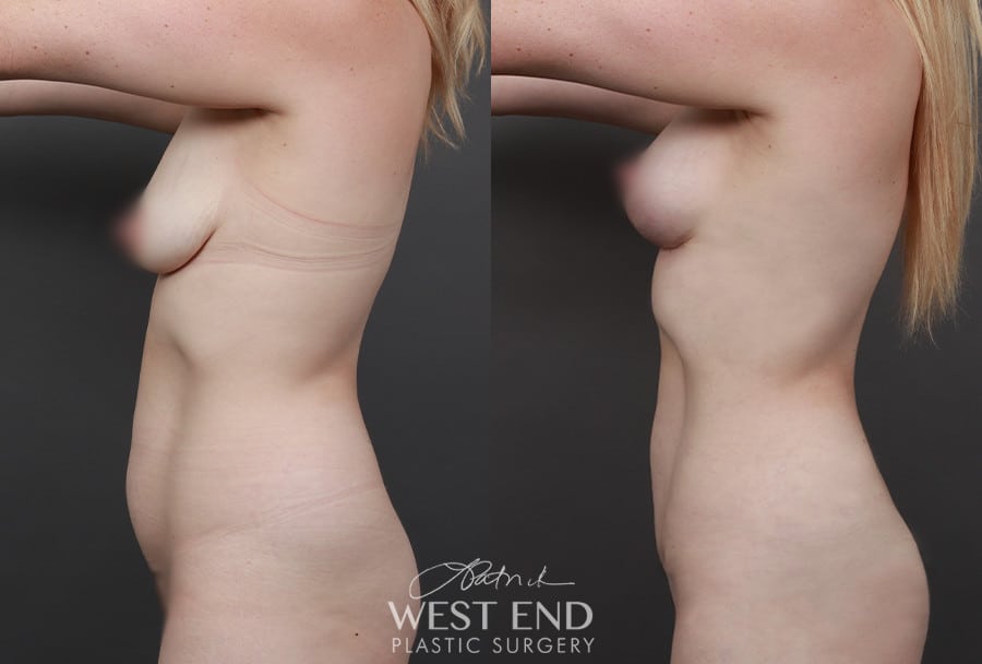 Mini Tummy Tuck with Liposuction & Breast Lift with Fat Grafting before photo. Individual results may vary.