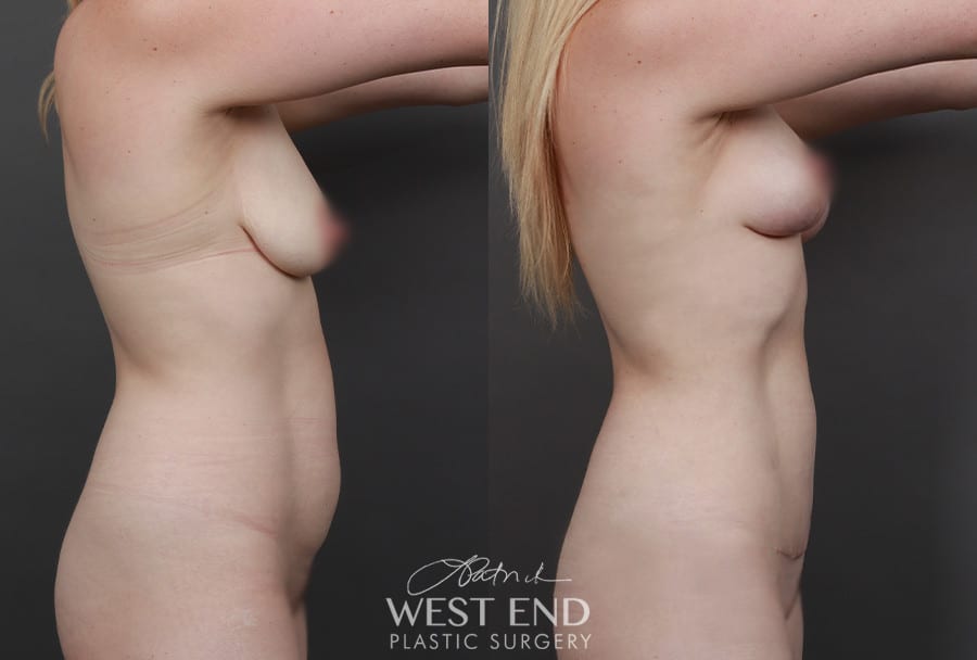 Mini Tummy Tuck with Liposuction & Breast Lift with Fat Grafting