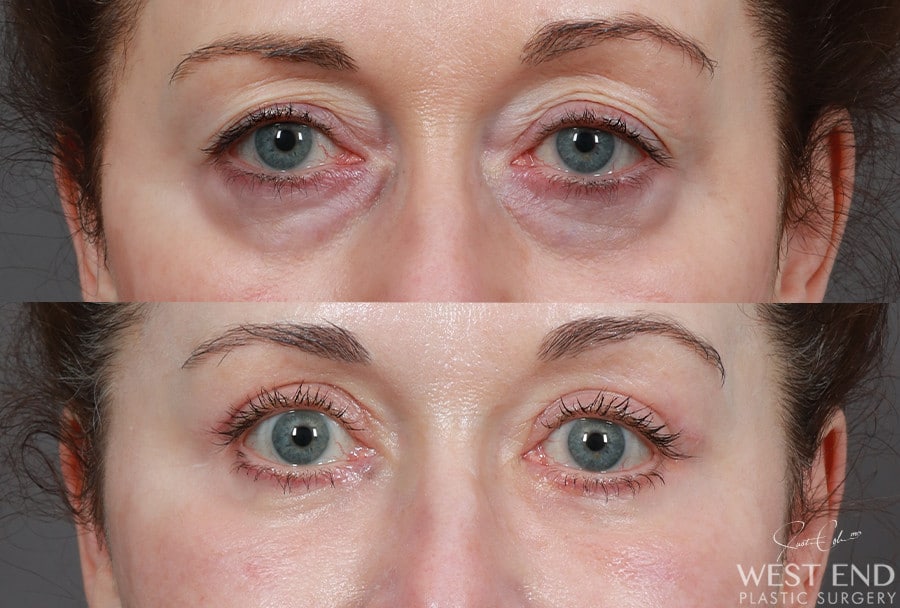Blepharoplasty, Fat Grafting & CO2 Laser Resurfacing before photo. Individual results may vary.
