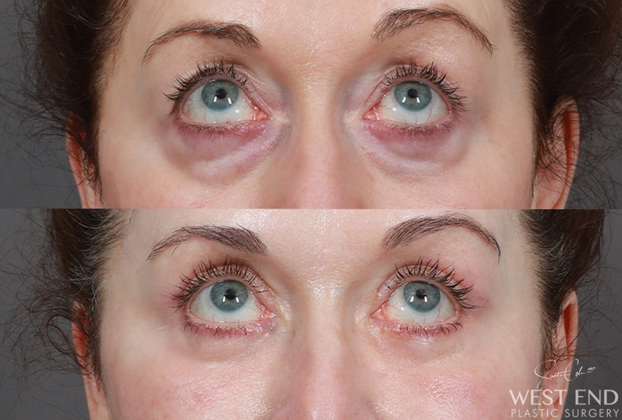 Blepharoplasty, Fat Grafting & CO2 Laser Resurfacing before photo. Individual results may vary.