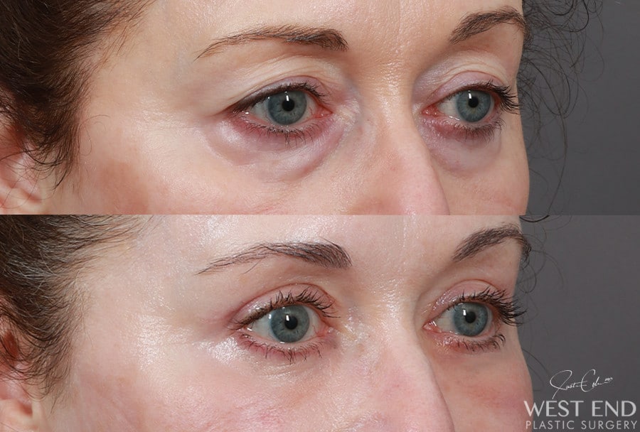 Blepharoplasty, Fat Grafting & CO2 Laser Resurfacing before photo. Individual results may vary.