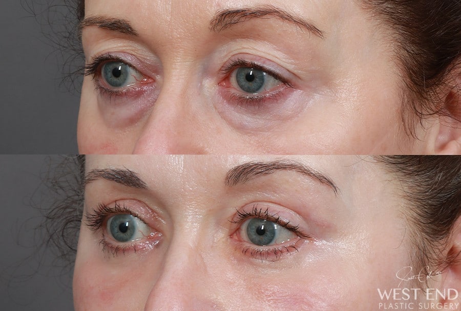 Blepharoplasty, Fat Grafting & CO2 Laser Resurfacing before photo. Individual results may vary.