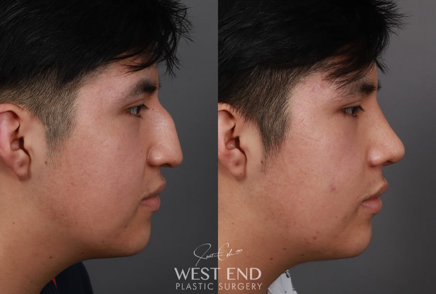 Rhinoplasty before photo. Individual results may vary.