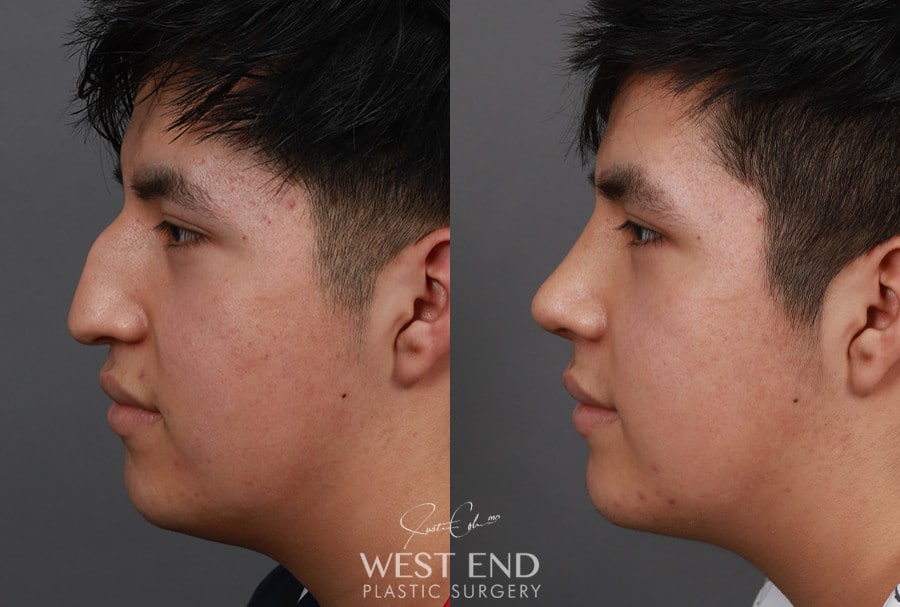 Rhinoplasty before photo. Individual results may vary.