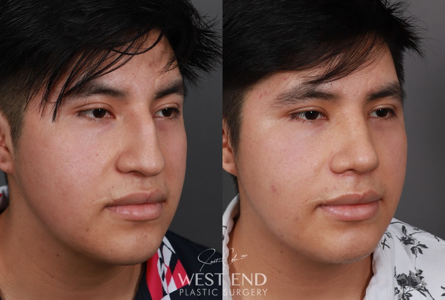 Rhinoplasty before photo. Individual results may vary.