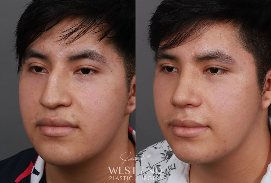 Rhinoplasty before photo. Individual results may vary.