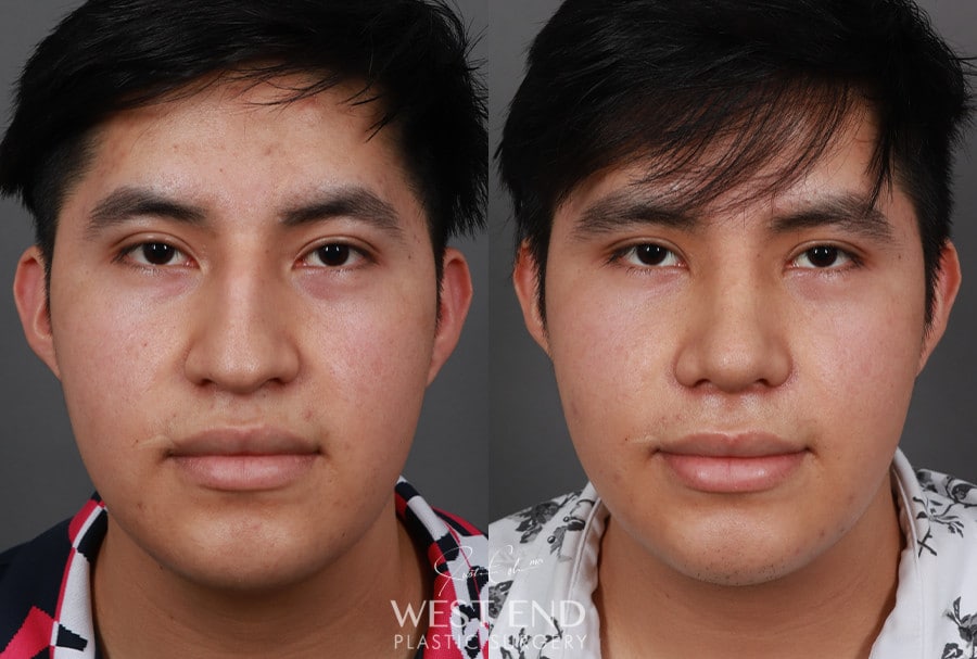 Rhinoplasty before photo. Individual results may vary.