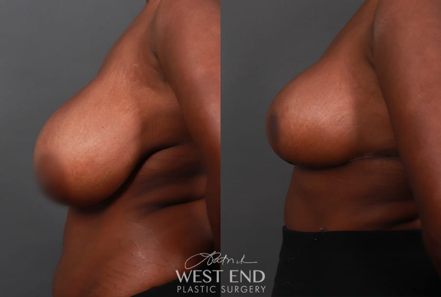 Breast Reduction (3 Weeks Post-Op)
