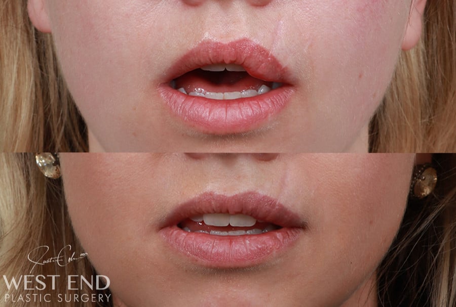 Upper Lip Vermilion Reduction – Scar Revision (Dog Bite) before photo. Individual results may vary.