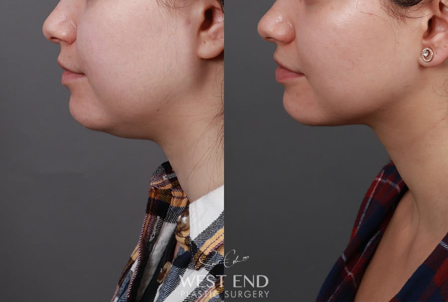Liposuction & Buccal Fat Pad Removal before photo. Individual results may vary.