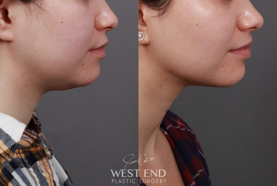 Liposuction & Buccal Fat Pad Removal before photo. Individual results may vary.