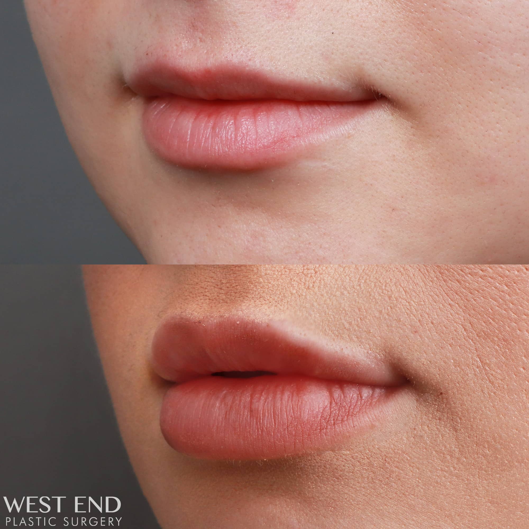 Lip Filler