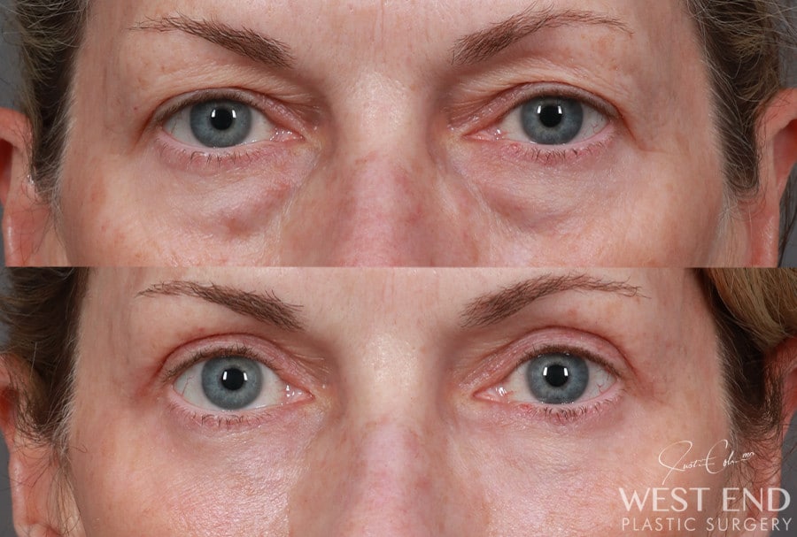 Blepharoplasty, Fat Grafting & CO2 Laser Resurfacing before photo. Individual results may vary.