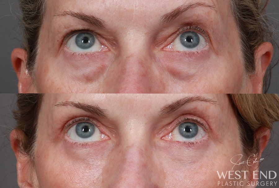 Blepharoplasty, Fat Grafting & CO2 Laser Resurfacing before photo. Individual results may vary.