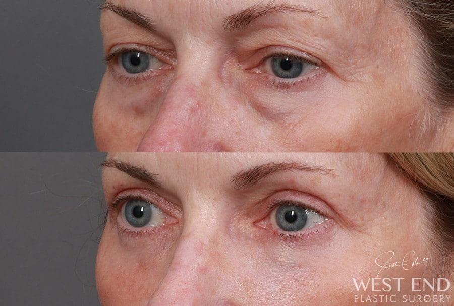 Blepharoplasty, Fat Grafting & CO2 Laser Resurfacing before photo. Individual results may vary.