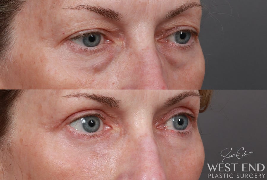 Blepharoplasty, Fat Grafting & CO2 Laser Resurfacing before photo. Individual results may vary.