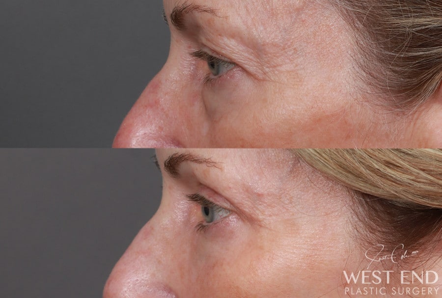 Blepharoplasty, Fat Grafting & CO2 Laser Resurfacing before photo. Individual results may vary.