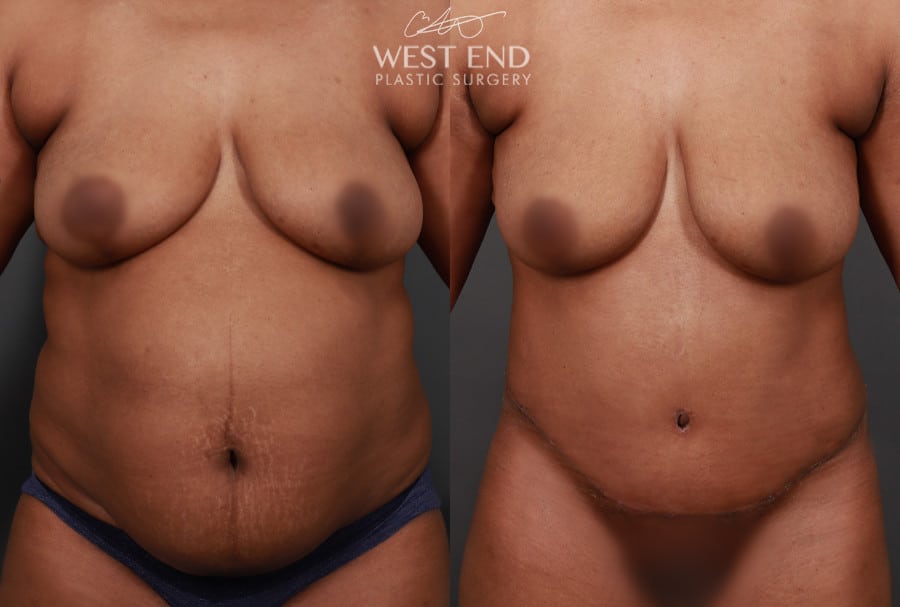 Tummy Tuck with Liposuction & Renuvion Skin Tightening