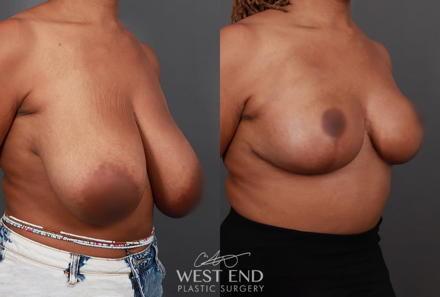 Breast Reduction (1.5 Months Post-Op)