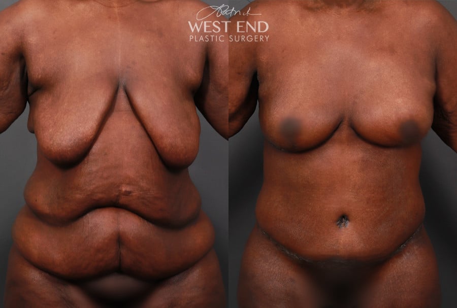 Post Weight Loss: Breast Lift, Tummy Tuck, and Liposuction (2 Weeks Post-Op)