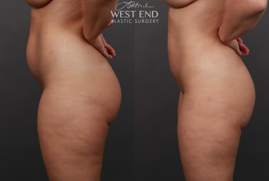 Liposuction and Renuvion Skin Tightening (1 Month Post-Op)